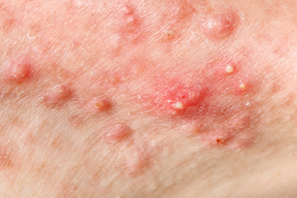 Acne Close Up