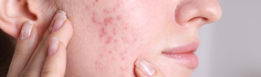 Acne Scars Header Image