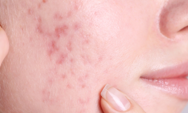 Acne Scars Header Image