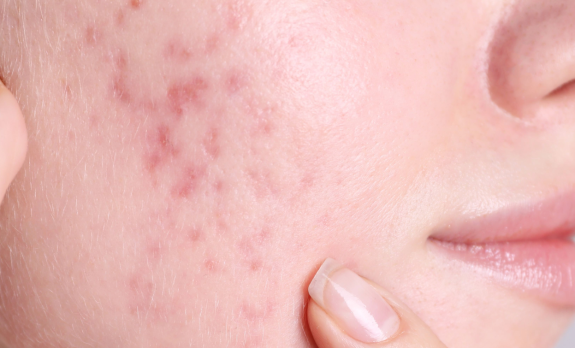Acne Scars Header Image