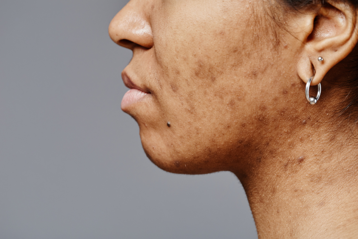 Acne Scars Condition
