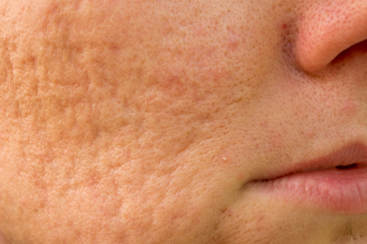 Acne Scars Condition