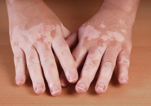 Vitiligo On Hands