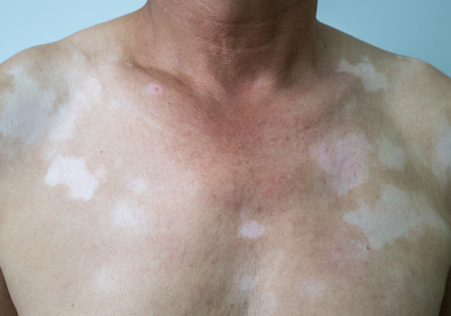 Vitiligo On Body