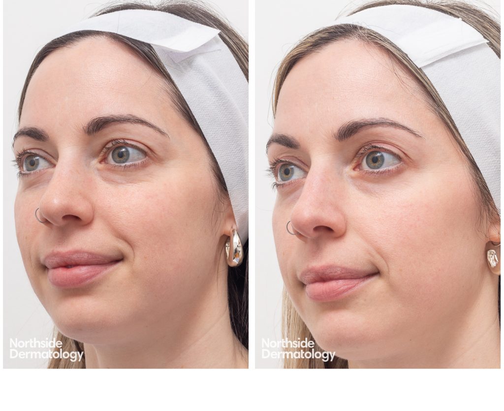 2468 AM 081191 CO2 COOL PEEL 1 session 2 weeks apart b and a