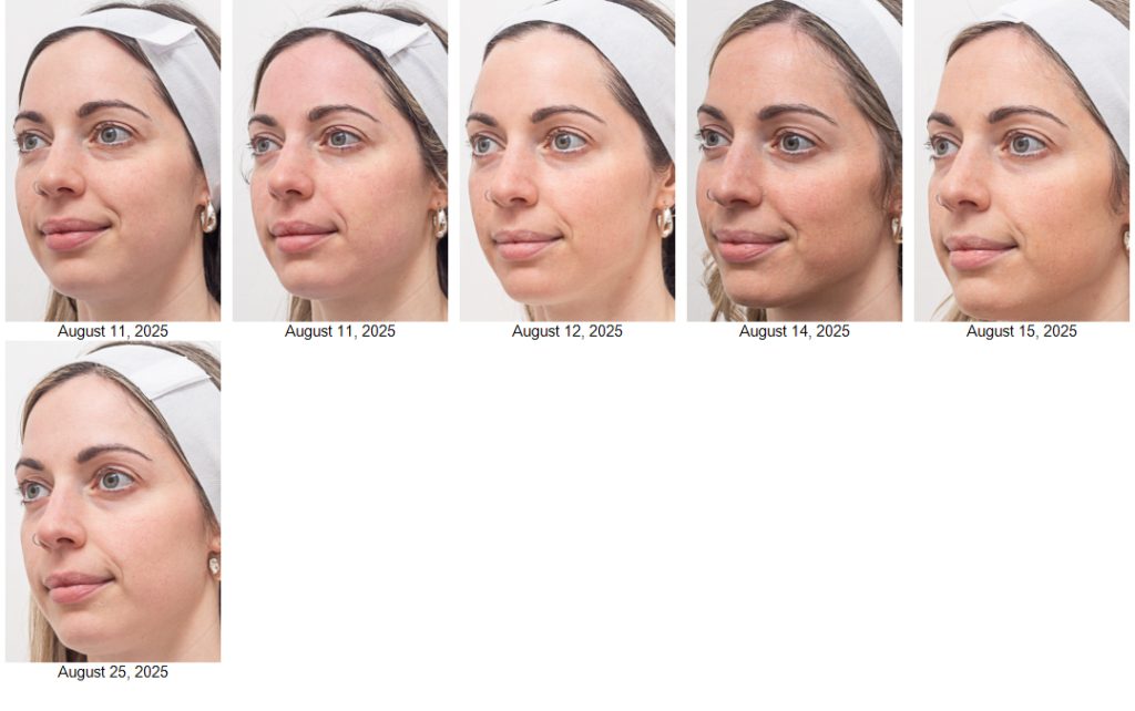 2468 AM 081191 CO2 COOL PEEL progress pics (1)