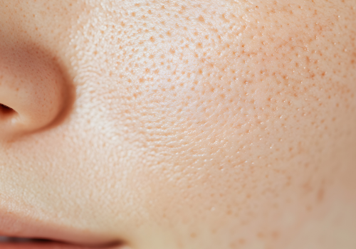 Pores On Cheek