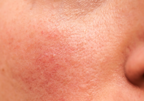 Skin Redness