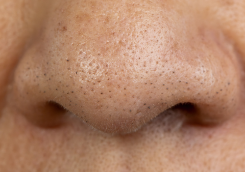 Pores On Nose