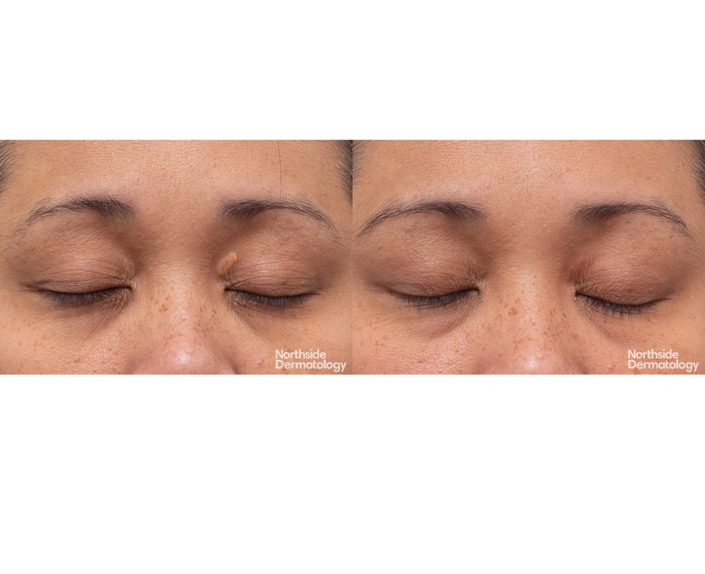 2473 YW 090581 CO2 XANTHELASMA 1 session