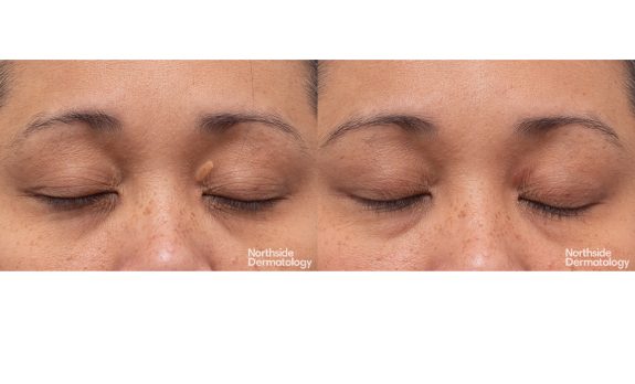 2473 YW 090581 CO2 XANTHELASMA 1 session