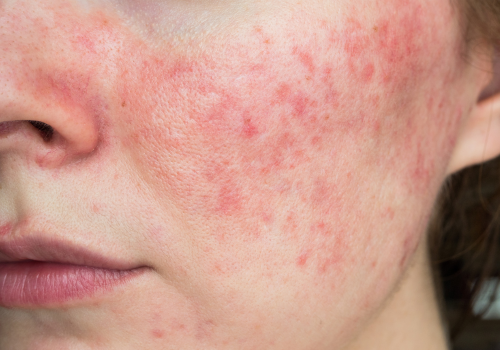 Rosacea Cheek