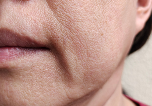 Sagging Skin Treatments