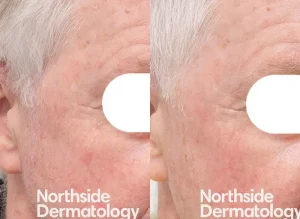 photodynamic therapy sun damage solar keratosis