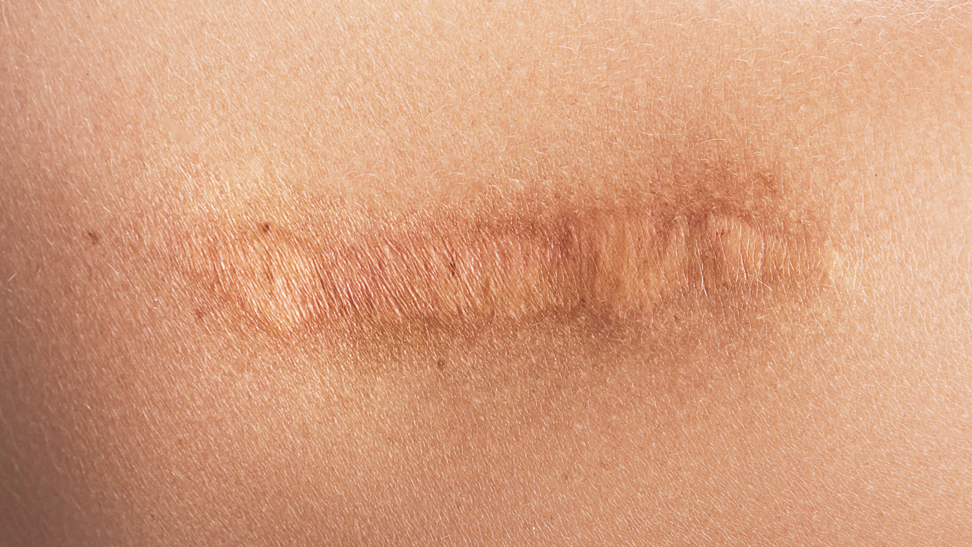 scar