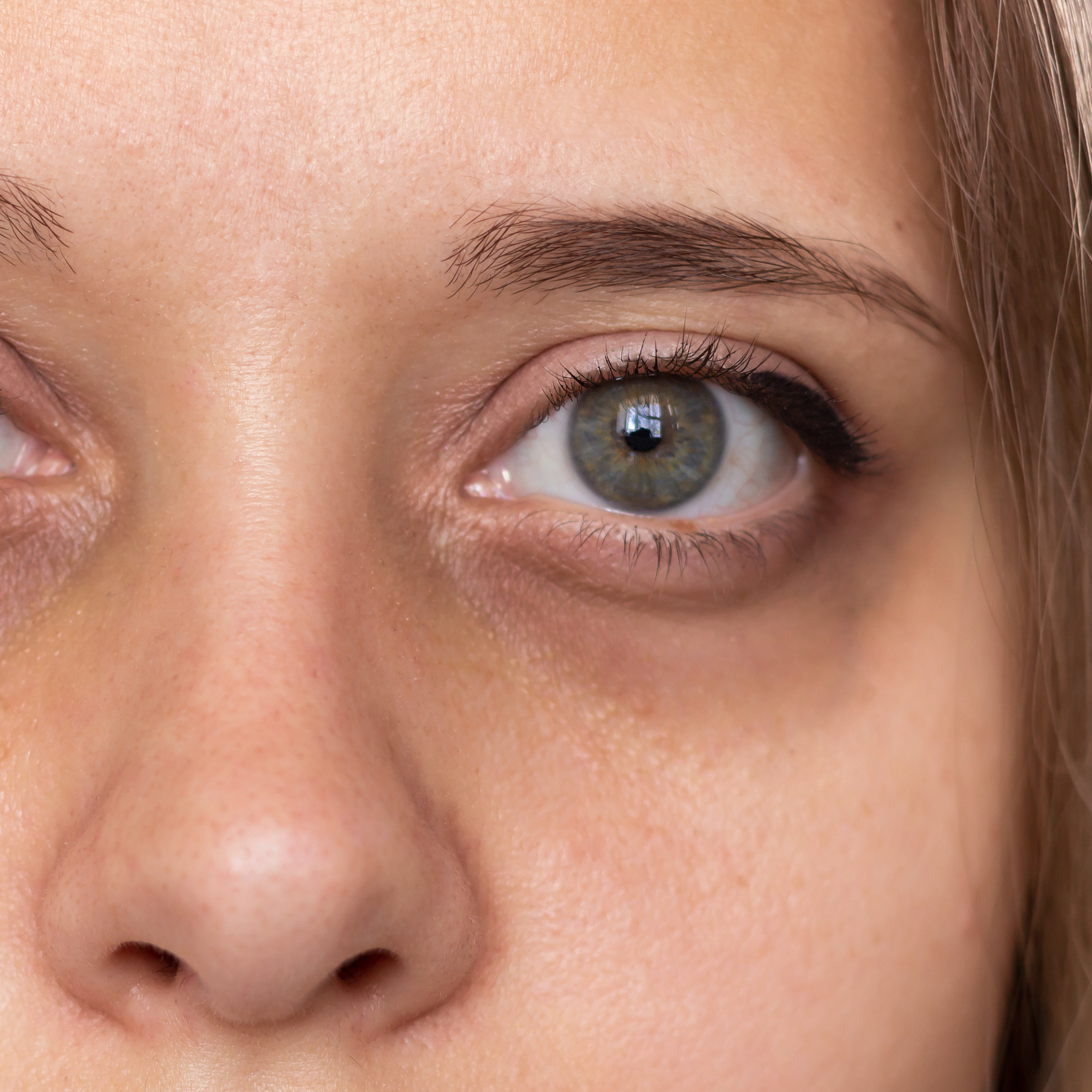 Dark Under Eye Circles