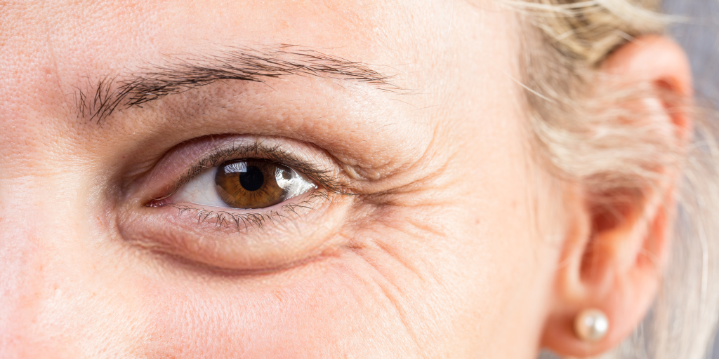 Dermatologist Treatment Crows Feet