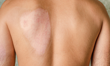 burn scar