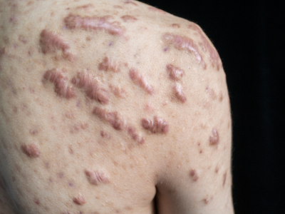Keloids Removal Melbourne
