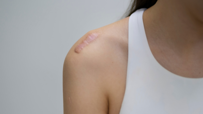keloid scar