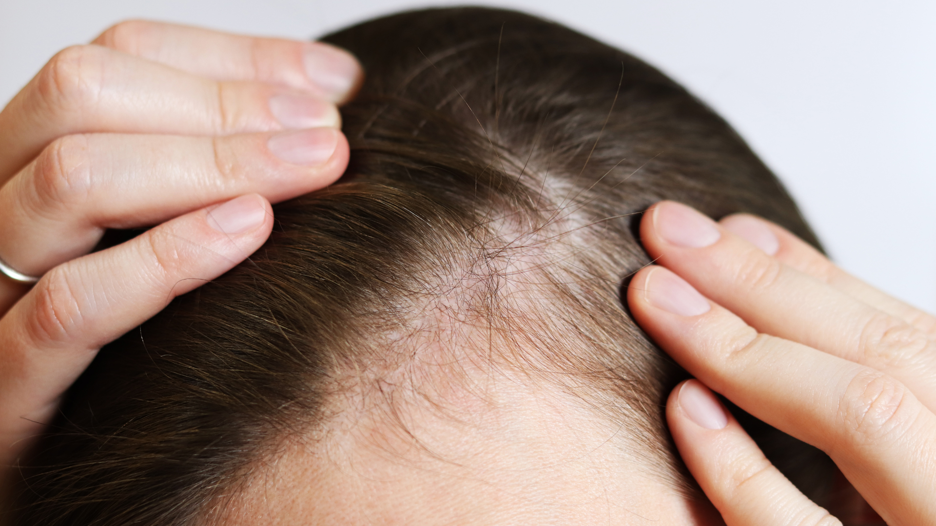 Hair loss and Alopecia Treatments